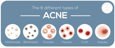 Types Of Acne Nodules