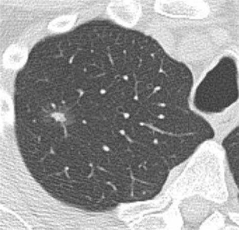 71 Year Old Man With A Part Solid Nodule In The Right Upper Lobe 15 Mm Download Scientific