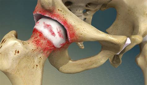 Exploring The Potential Of Stem Cell Therapy For Osteoarthritis Of The Hip