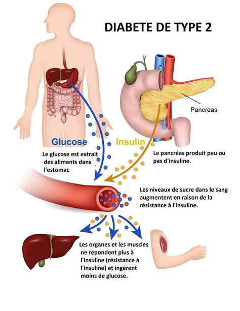 Diabète de type 2 signes cause traitement héréditaire