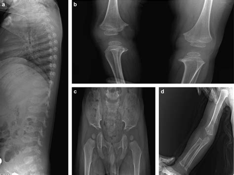 Radiographic Findings In The PSACH Proband A Radiograph Showing