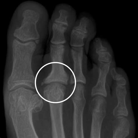 Second Toe Joint Interposition — Daniel Bohl Md Midwest Orthopaedics At Rush