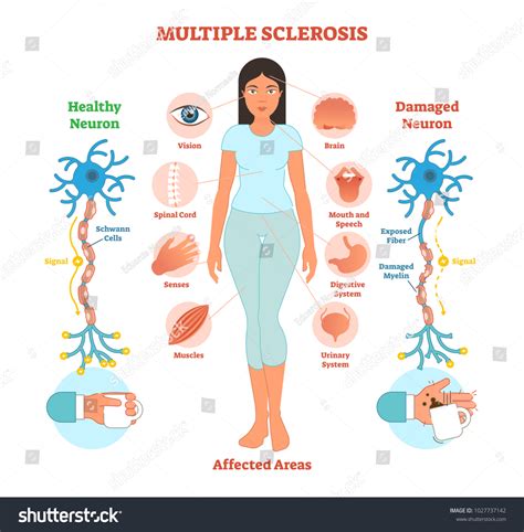 Multiple Sclerosis Anatomical Vector Illustration Diagram Stock Vector Royalty Free 1027737142