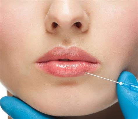 Lippen aufspritzen lassen | hukendu Ratgeber