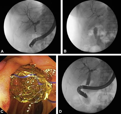 Clinical Efficacy Of Anti Migration Features In Fully Covered Metallic