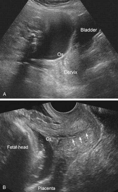 ultrasound evaluation   placenta membranes  umbilical cord
