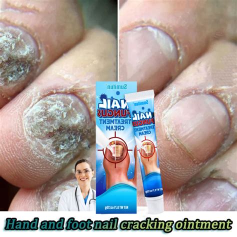 Nail Fungus Repair Nail Repair Liquid 20g Fast Repair Damaged Nails