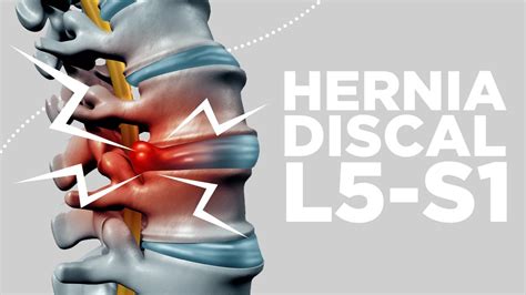 HERNIA DISCAL L5 S1 síntomas y soluciones YouTube