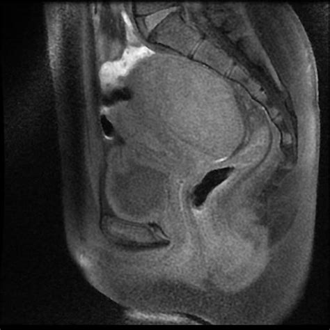 Ovarian Torsion Image