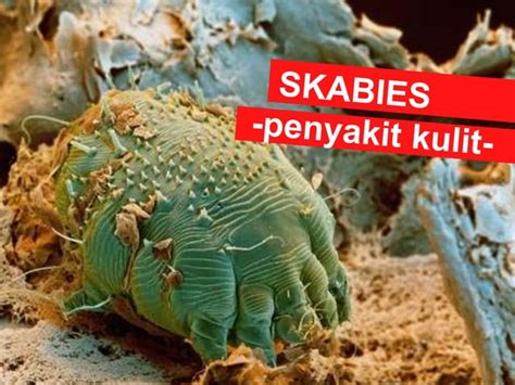 Skabies PPT