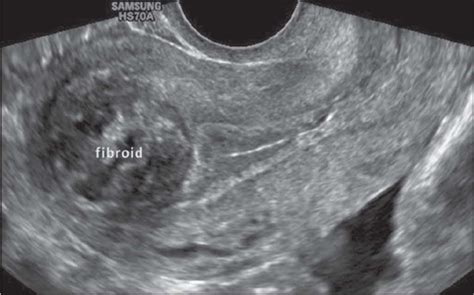 Transvaginal Ultrasound Fibroids