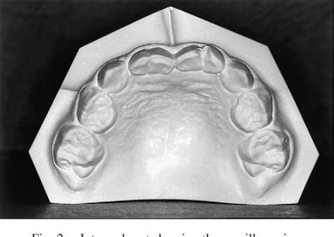 Figure 2 From Four Fused Incisors In The Maxillary And Mandibular