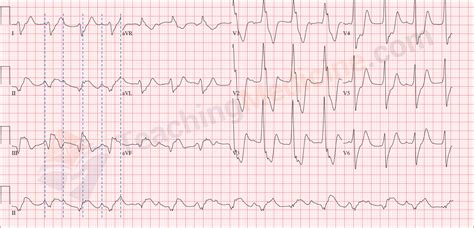 Teaching Medicine - Tutorial: Rhythm Diagnostic Criteria