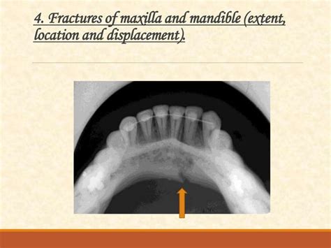 Occlusal Radiography Ppt