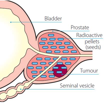 Brachytherapy for prostate cancer | Irish Cancer Society