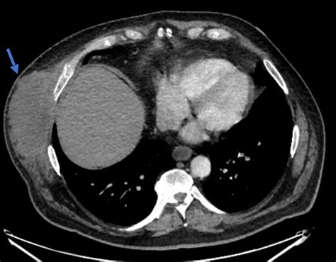 Chest Wall Lumps Rib Injury Clinic