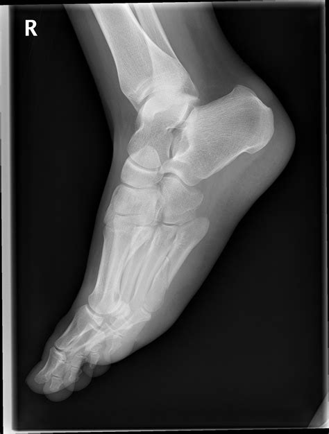 Spiral Fracture Fifth Metatarsal Shaft Image