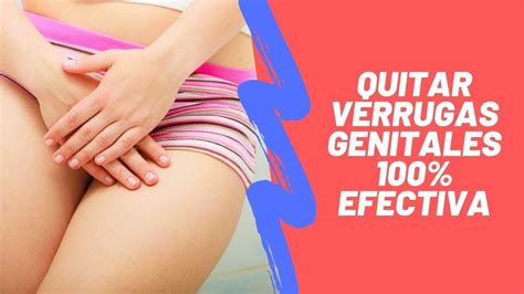 COMO ELIMINAR VERRUGAS GENITALES DE FORMA 100 EFECTIVA Y SIN