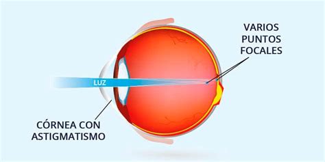 Astigmatismo Qué es Síntomas Causas y Tratamiento