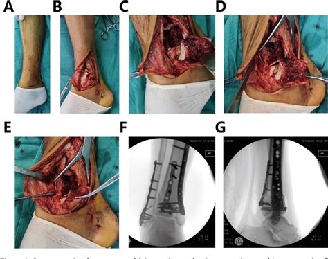 Figure 1 From Early Reduction Of The Posterior Column A Surgical