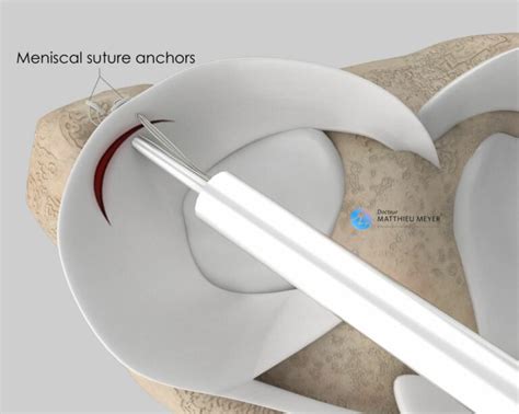 Arthroscopic Meniscal Surgery Doctor Matthieu Meyer