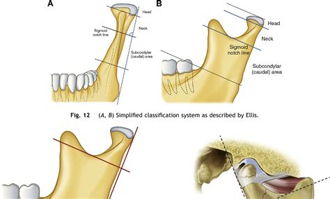 Mandibular Fracture Classification