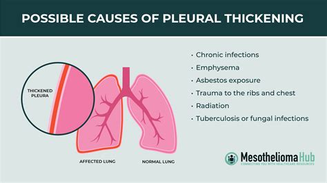 Pleural Thickening Symptoms, Causes And Treatment, 48% OFF