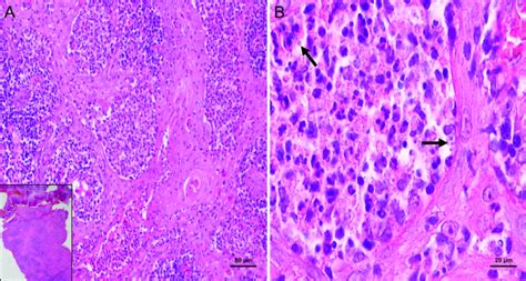 Mucosal Leishmaniasis Of The Lip Report Of An Exuberant Case In A