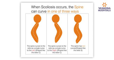 Right Scoliosis Symptoms Causes And Treatment