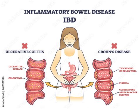 Inflammatory Bowel Disease Or Ibd With Crohns Condition And Ulcerative