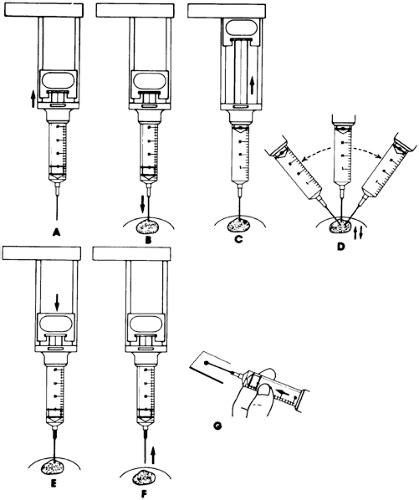 THYROID NEEDLE ASPIRATION AND BIOPSY | Oncohema Key