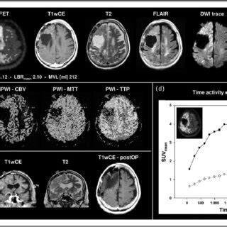 Multimodal Noninvasive Evaluation In Mri Negative Operculoinsular