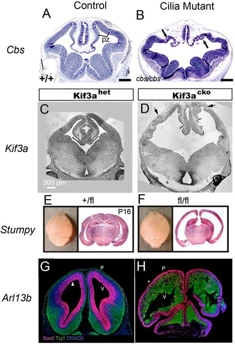 Cilia Mutations And Disrupted Corticogenesis A B Mutation Of Cbs A Download Scientific