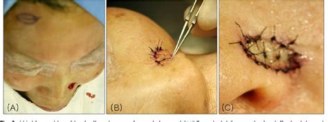 Figure From The Full Thickness Forehead Skin Graft For A Nasal Ala