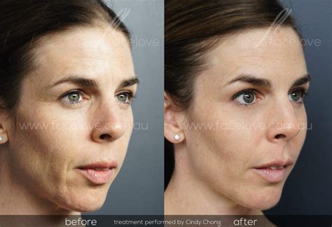 Cheek Augmentation Facelove