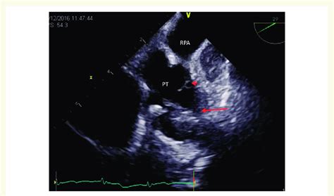 Transoesophageal Echocardiogram Red Arrow Head Pointing To A Download Scientific Diagram