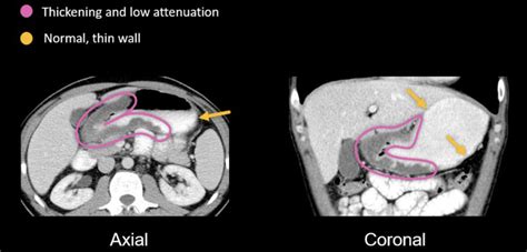 Abdominal CT: peptic ulcer disease • LITFL • Radiology Library