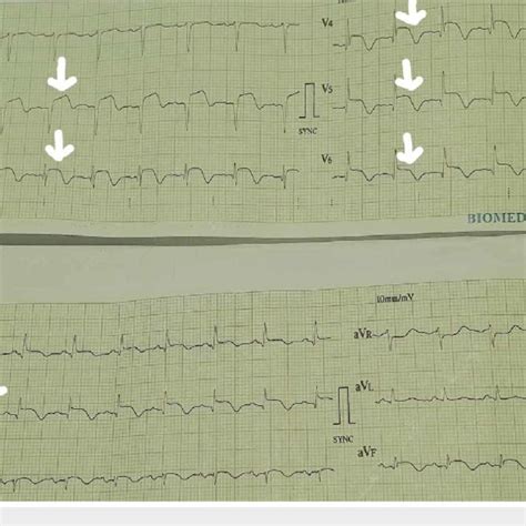 Electrocardiogram Showing St Segment Elevation V V Ii Iii Avf