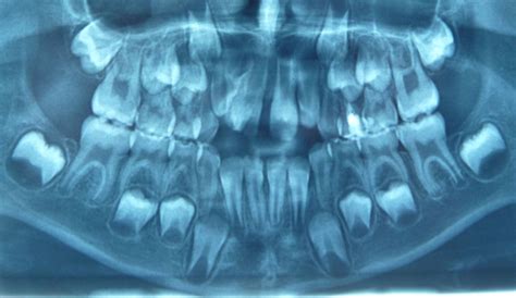 Management Of Non Syndromic Dens Evaginatus Affecting Permanent