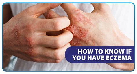 Reasons Why You Shouldnt Ignore Eczema Regional Allergy 50 Off