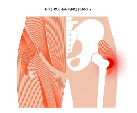 160+ Hip Bursitis Stock Photos, Pictures & Royalty-Free Images - iStock