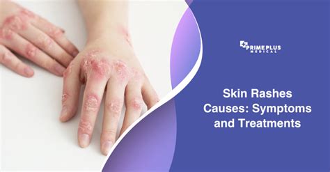 Skin Rashes Causes: Symptoms and Treatments - Prime Plus Medical