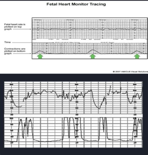 Fetal Monitoring Flashcards Quizlet