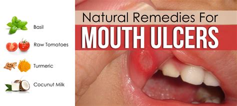 Natural Remedy For Mouth Ulcer | Being Girlish