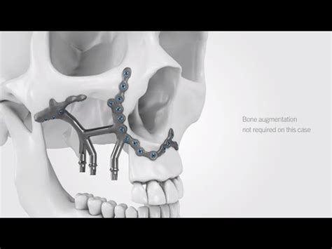 Ips Implants Preprosthetic Treatment Workflow Youtube