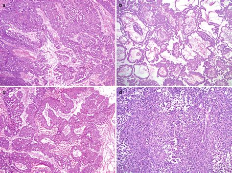 Ovarian Epithelial Tumors Basicmedical Key