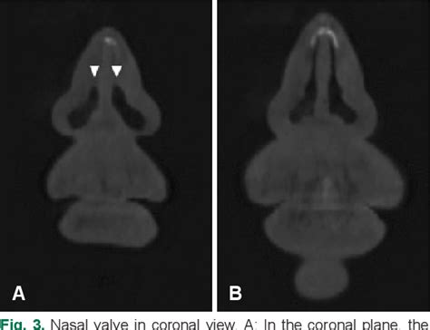 Figure 3 From Definition Of Nasal Valve Location And Classification Of