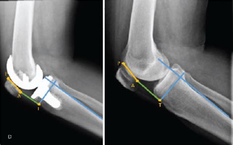 Scielo Brasil The Variation Of The Patellar Height In Total Knee