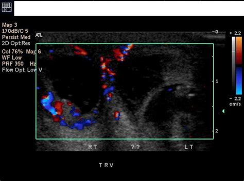 Testicular Infarction Becoming Apparent After Hernia Reduction