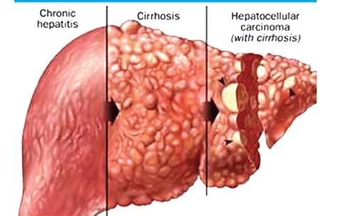 Hepatitis causes, Hepatitis symptoms, Hepatitis prevention, Hepatitis treatment. - The News ...